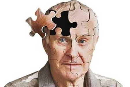 آلزایمر،اخبار پزشکی،خبرهای پزشکی