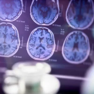 هوش مصنوعی با یک اسکن به تشخیص 9 نوع زوال عقل با دقت 88 درصدی کمک می‌کند